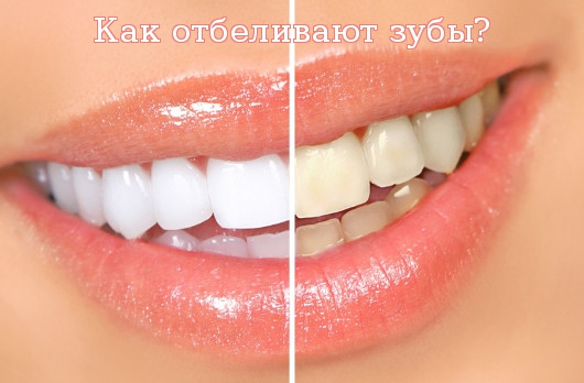 Как отбеливают зубы?